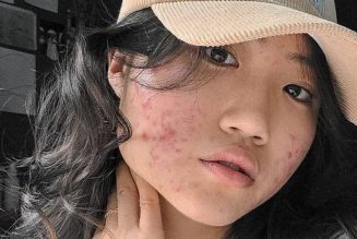 This Is the Best Skincare Routine For Acne, According to a Dermatologist