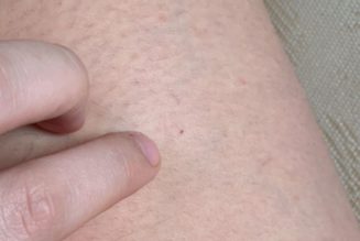 Woman Says She Was Injected With Unknown Substance at Nottingham Nightclub