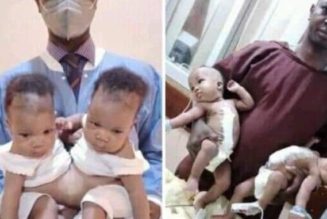 Team of Nigerian Doctors Separate Con-Joined Twins at University of Ilorin (Photo)