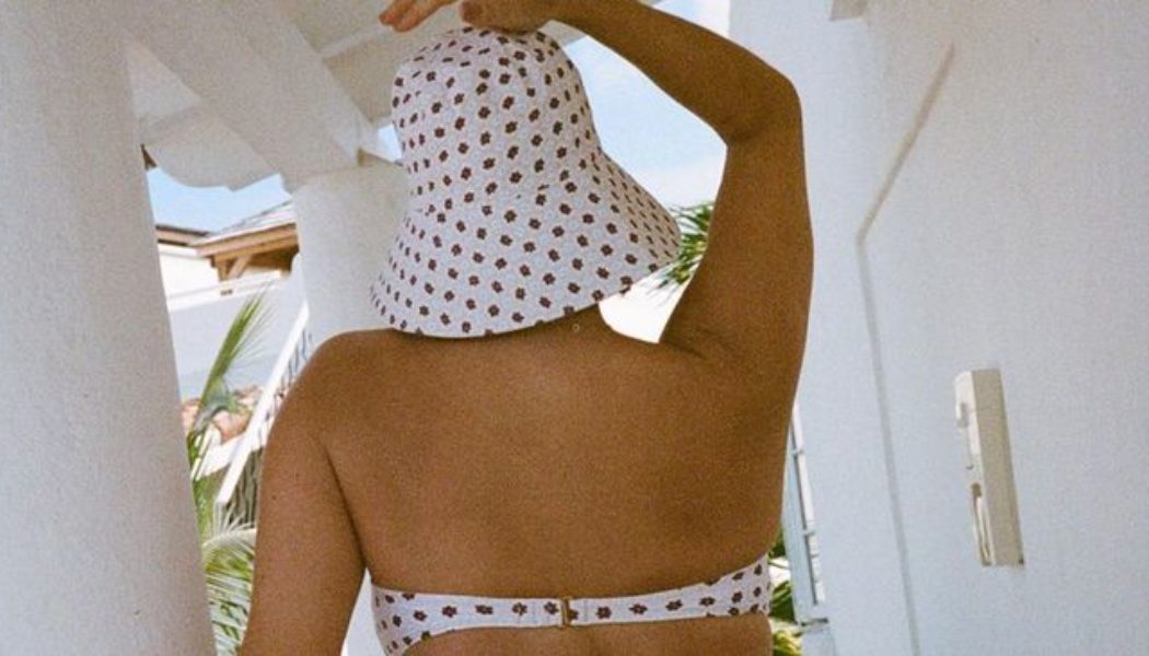 Sunburn Happens to the Best of Us—Here’s How to Treat It