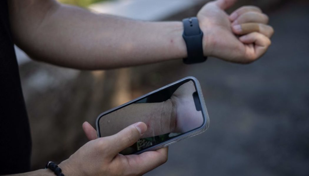 Monkeypox Surges In DC, Health Officials Move To Distribute Vaccines As They Become Available