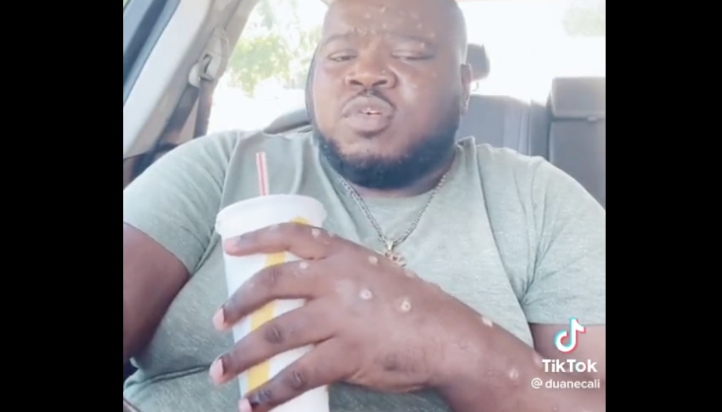 TikToker Goes On “McDonald’s Run” While Suffering From Monkeypox, Twitter Disgusted