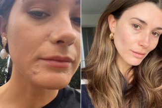I Tried Everything for Acne, But This Dermatologist Recommendation Worked