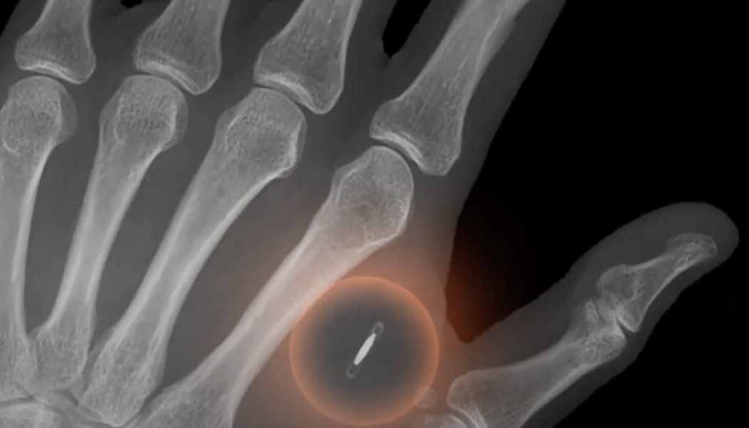 Not medical advice: Bitcoiner implants Lightning chip to make BTC payments by hand