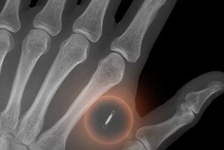 Not medical advice: Bitcoiner implants Lightning chip to make BTC payments by hand