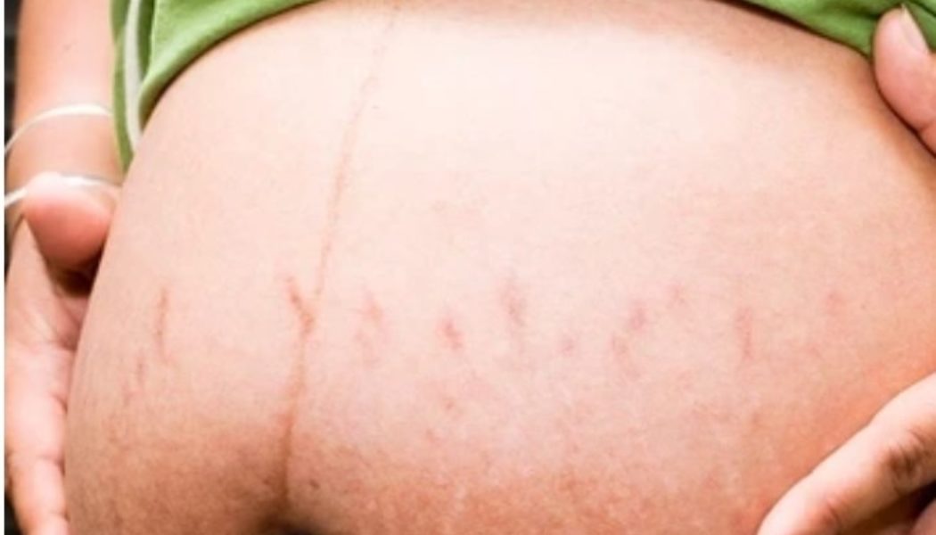 What is linea nigra? All you need to know.