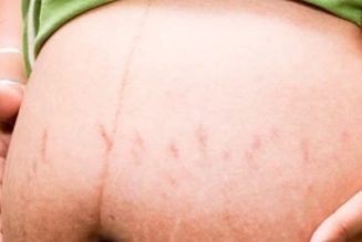 What is linea nigra? All you need to know.