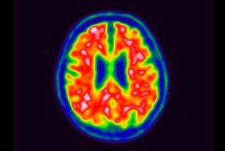 Alzheimer’s among seniors is most common in these parts of the US, first-of-its-kind data shows | CNN