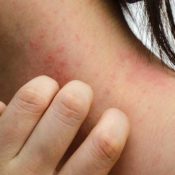 How Lifestyle Changes and Self-Care Can Improve Your Eczema