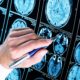 15 health and lifestyle risk factors for young-onset dementia revealed in new study
