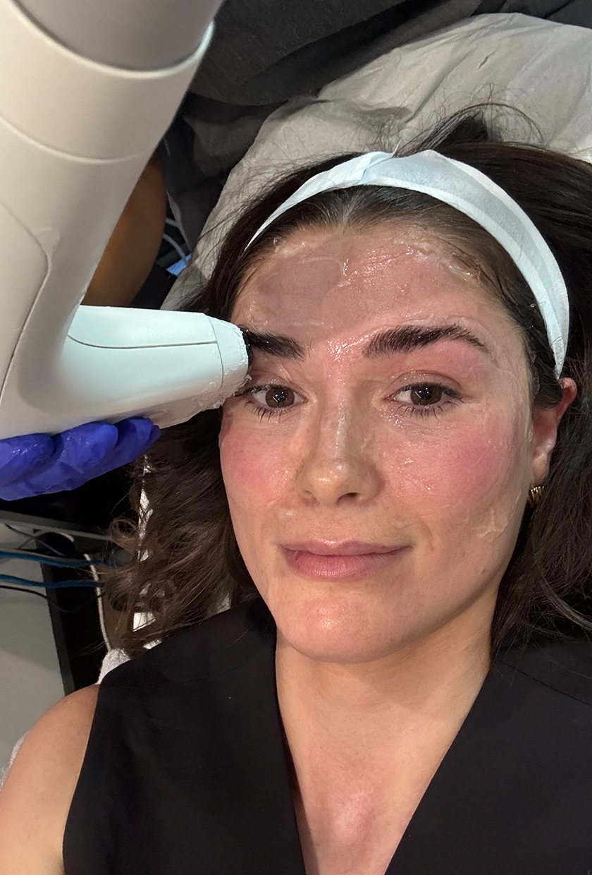 Eleanor during the Sofwave treatment, with the device on her eyebrows