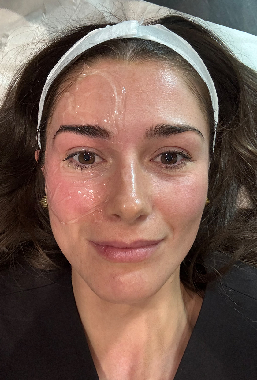 One side of the face treated with Sofwave vs the untreated side