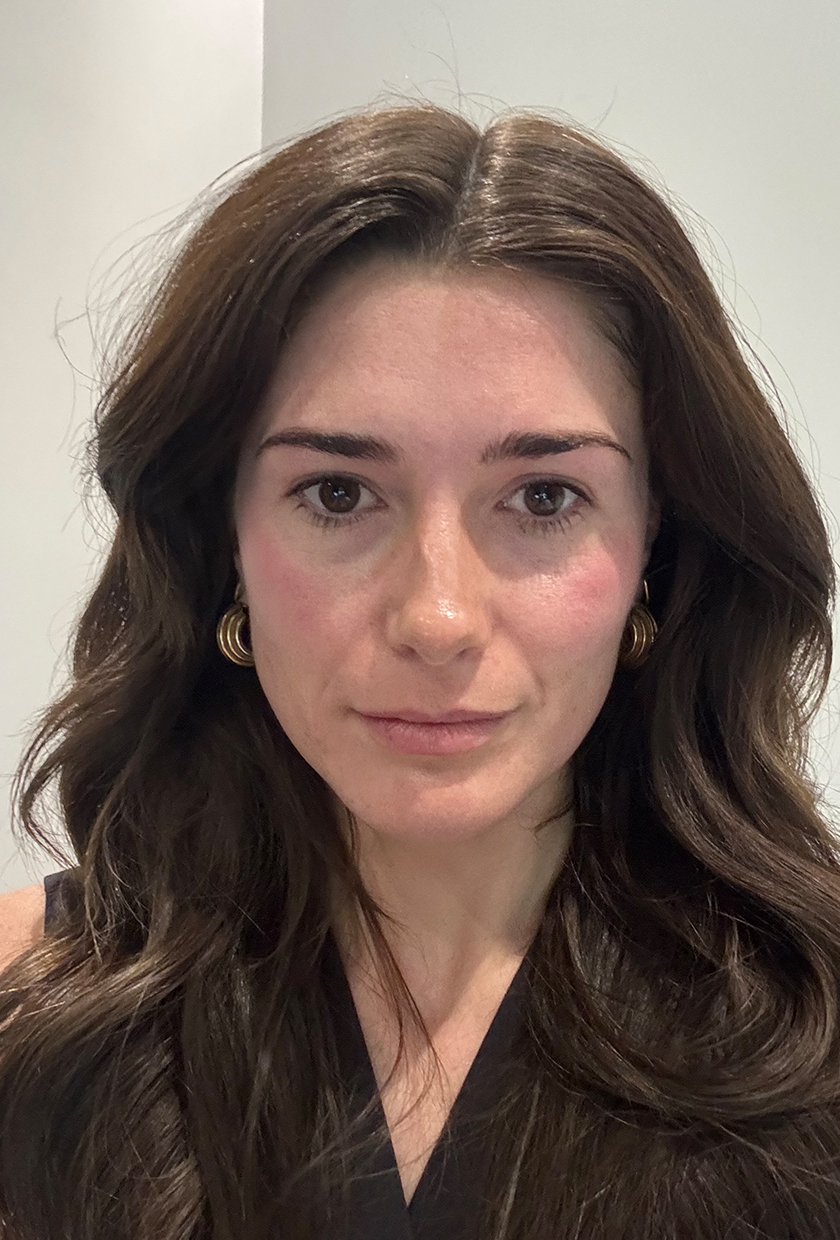 Immediately after the Sofwave treatment