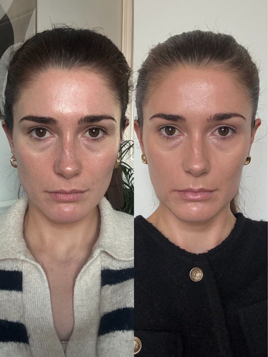 Sofwave brow treatment before and after 3 months