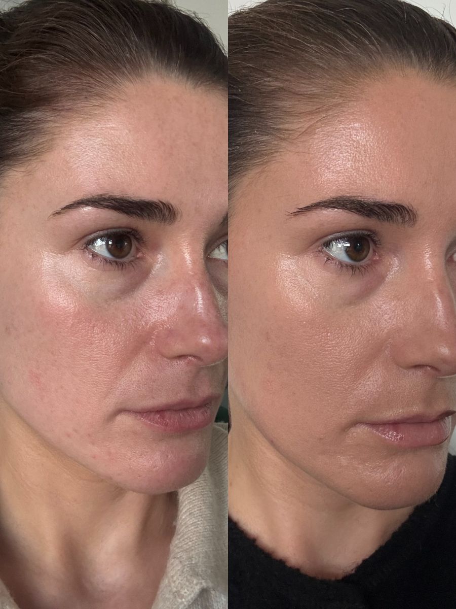 Side by side before and after of the eyes and brows 3 months after having a Sofwave treatment