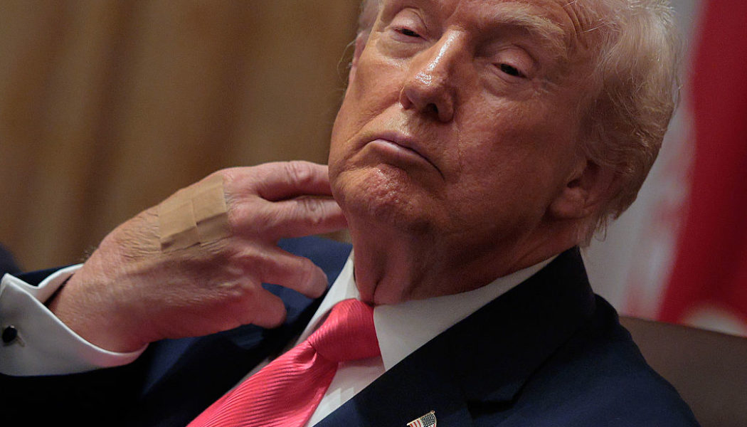 Trump's Bandaged Hand Caught On Camera Again