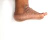 Beyond dehydration, medical conditions that put you at risk