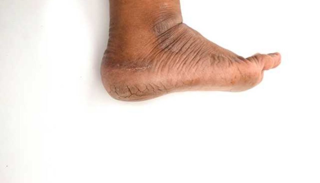 Beyond dehydration, medical conditions that put you at risk